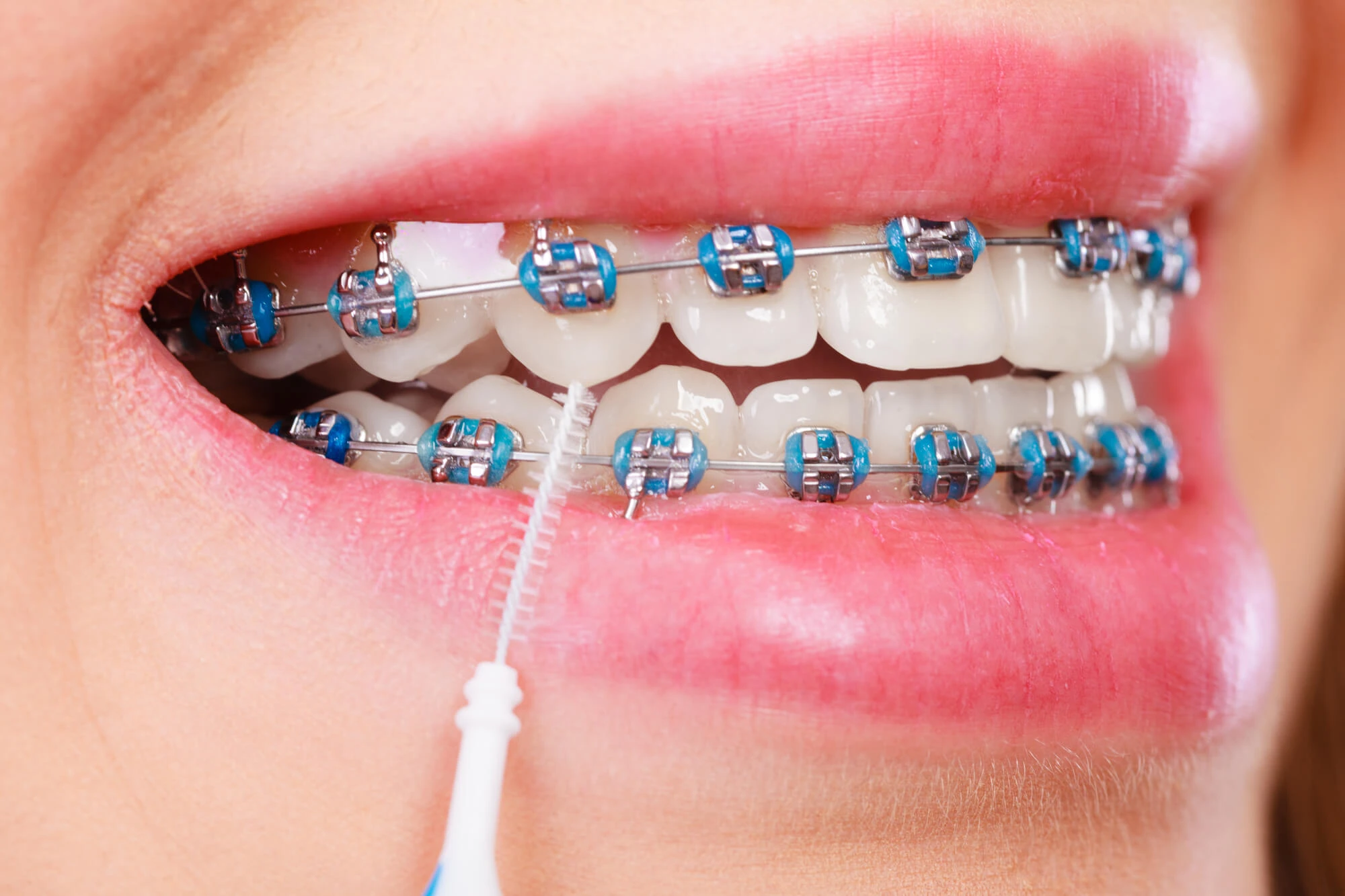 Aparelho ortodôntico fixo com brackets